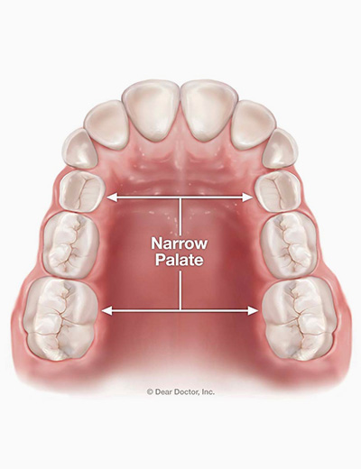 Align Technology Introduces the Invisalign® Palatal Expander System to  Address Skeletal Expansion in Growing Patients, Including Teenage Patients  Which Represent the Majority of Orthodontic Case Starts Globally