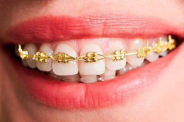 braces gold Harrisonburg