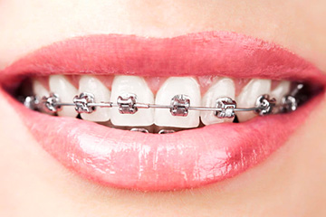 thumb-braces-silver