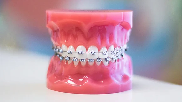 MetalBraces_WeilerOrtho MetalBraces WeilerOrtho